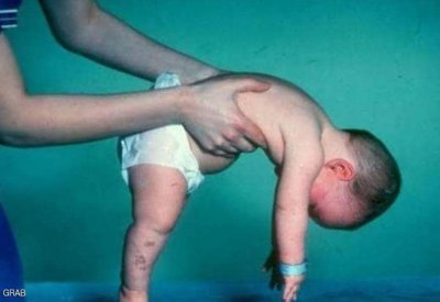 بعد قرار السيسي تحمل تكلفة علاجه.. ما هو مرض الضمور العضلي؟
