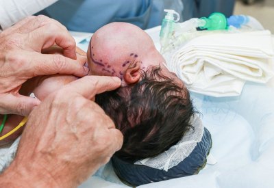 "الملك حمد الجامعي" ينقذ رضيعة عمرها أقل من شهر بعد إصابتها بورم في الرقبة