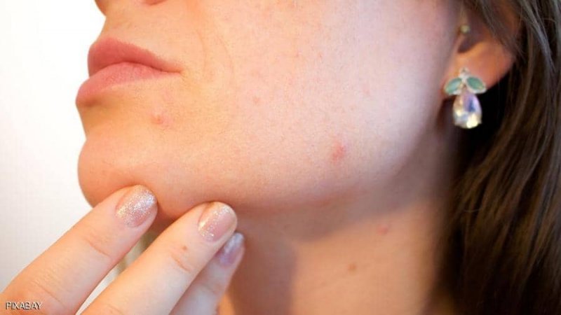 لبشرة خالية من حب الشباب.. تجنبوا تناول هذه الأطعمة