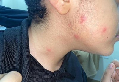 أطفال سلماباد يعانون من لدغات بعوض المستنقعات
