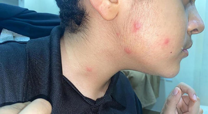 أطفال سلماباد يعانون من لدغات بعوض المستنقعات