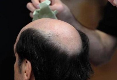 تمثل اضطرابا صحيا.. لا تتجاهل هذه العلامة في فروة الرأس