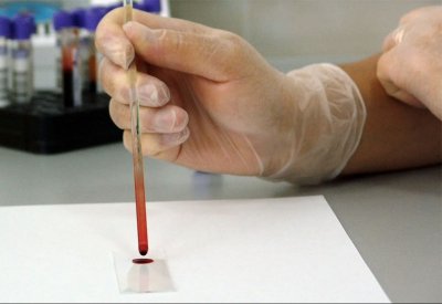 سريع وغير مكلف.. اختبار جديد يكشف سرطان البروستاتا
