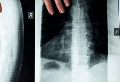 تطور طبي "مثير" قد يشفي حالات الشلل بنجاح