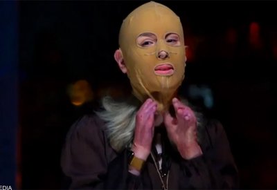 بالفيديو: مصابة بلهيب بركان مدمر تكشف عن وجهها لأول مرة