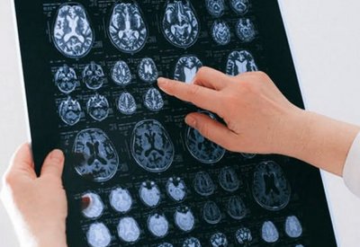 اضطراب نفسي يهدد بنية الدماغ.. دعوة للاستيقاظ