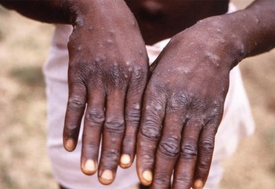 السودان يعلن تسجيل أول إصابة مؤكدة بجدري القردة