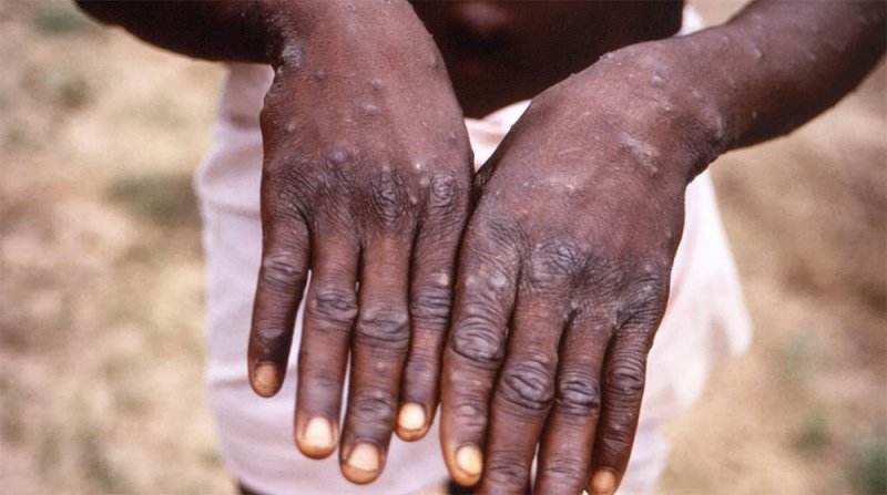 السودان يعلن تسجيل أول إصابة مؤكدة بجدري القردة