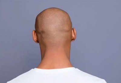 لا صلع بعد اليوم.. حبة صغيرة ورخيصة من علاج قديم تحدث فرقا