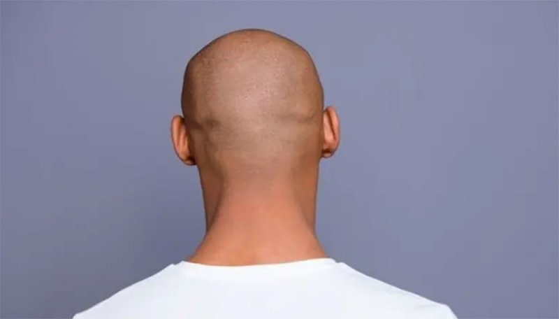 لا صلع بعد اليوم.. حبة صغيرة ورخيصة من علاج قديم تحدث فرقا
