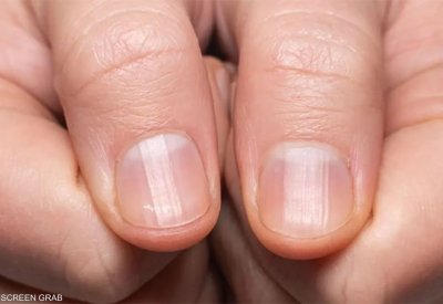 الخطوط على أظافرك.. "أسرار صحية" مرتبطة بالعمر