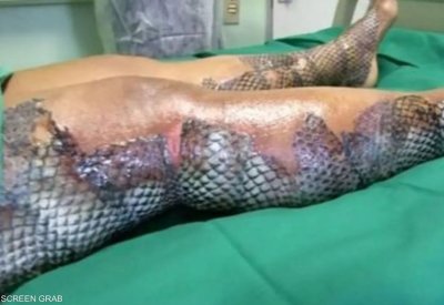 صورة لا تصدق لحروق امرأة.. الضماد الطبي حولها لسمكة