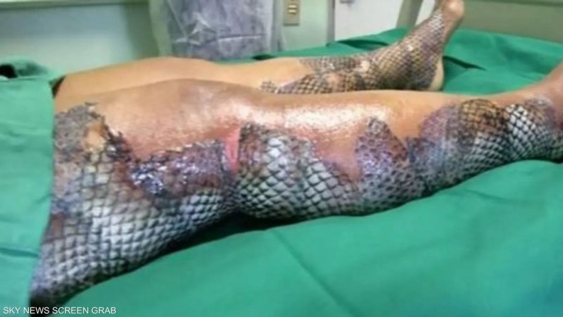 صورة لا تصدق لحروق امرأة.. الضماد الطبي حولها لسمكة