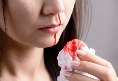 طبيبة روسية توضح الطريقة الصحيحة لوقف نزيف الأنف