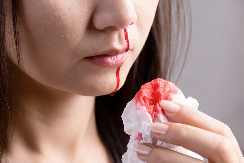 طبيبة روسية توضح الطريقة الصحيحة لوقف نزيف الأنف