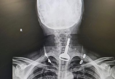 جراح سعودي ينقذ حياة أربعيني ابتلع مفتاح سيارته