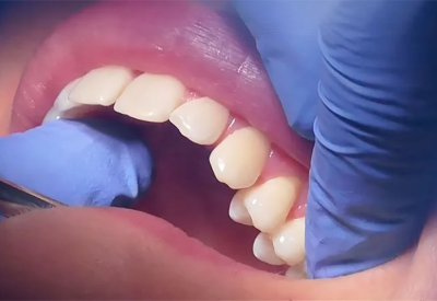 بعد اللبنية والدائمة.. دواء "يُنبت" جيلا ثالثا من الأسنان