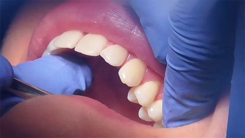 بعد اللبنية والدائمة.. دواء "يُنبت" جيلا ثالثا من الأسنان