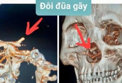 عيدان تناول طعام اخترقت أنف مريض لجمجمته وظلت 5 أشهر