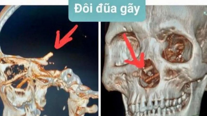عيدان تناول طعام اخترقت أنف مريض لجمجمته وظلت 5 أشهر