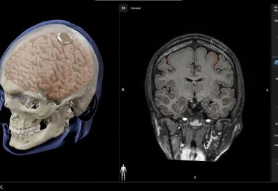 إيلون ماسك يعلن عن نجاح زرع شريحة دماغية في أول إنسان