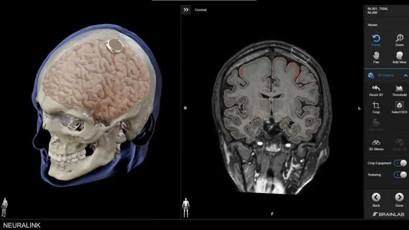 إيلون ماسك يعلن عن نجاح زرع شريحة دماغية في أول إنسان