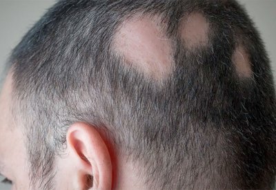 السلطات الصحية البريطانية تعتمد علاجا لداء "الثعلبة"