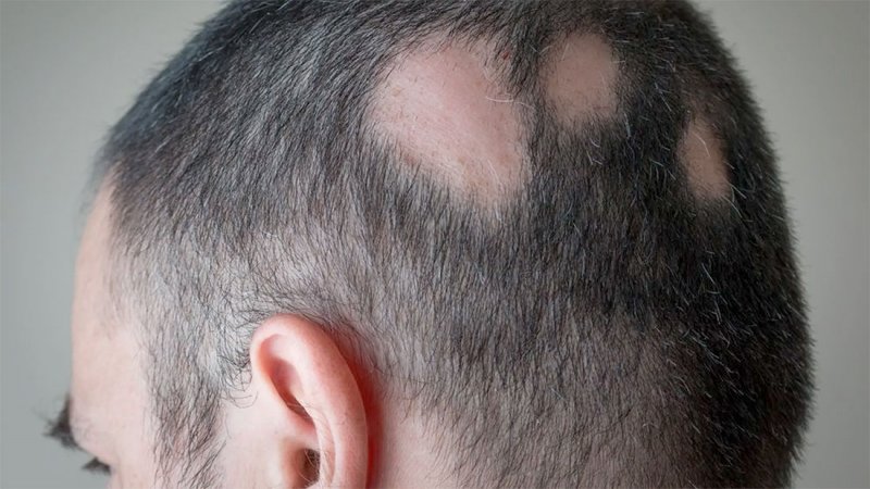 السلطات الصحية البريطانية تعتمد علاجا لداء "الثعلبة"