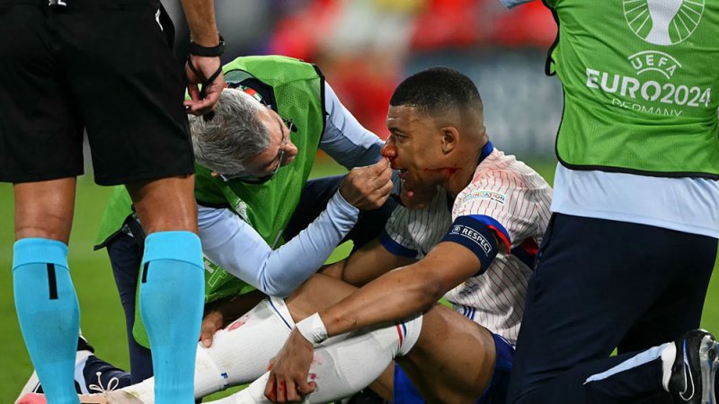 الاتحاد الفرنسي: مبابي يعاني من كسر في أنفه وسيرتدي قناعا