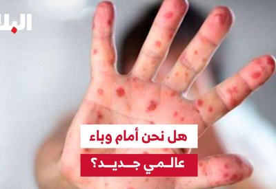 بالفيديو: جدري القردة.. هل نحن أمام وباء عالمي جديد؟