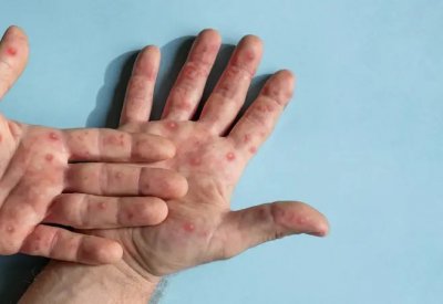 هل ظهر جدري القرود بمصر؟.. مسؤول يكشف