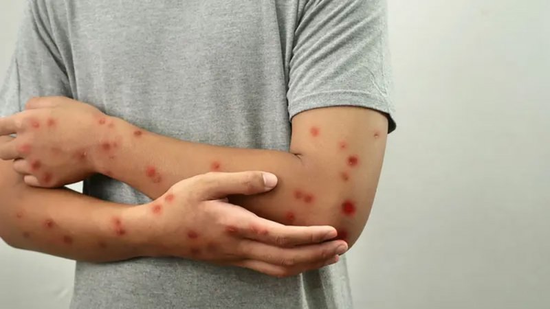 لماذا لم يتحول جدري القردة إلى وباء مثل كورونا؟ ..مسؤول مصري يجيب