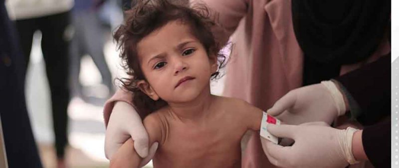 اليونيسف: 77 مليون طفل يعانون من سوء التغذية في الشرق الأوسط وشمال أفريقيا