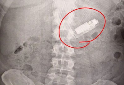 ابتلعه بطريق الخطأ قبل 5 شهور.. استخراج موبايل قديم من معدة مريض في مصر