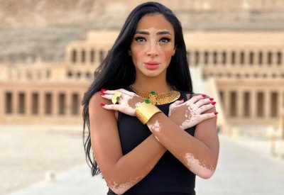لوجينا صلاح.. مصابة بالبهاق وملكة جمال الكون