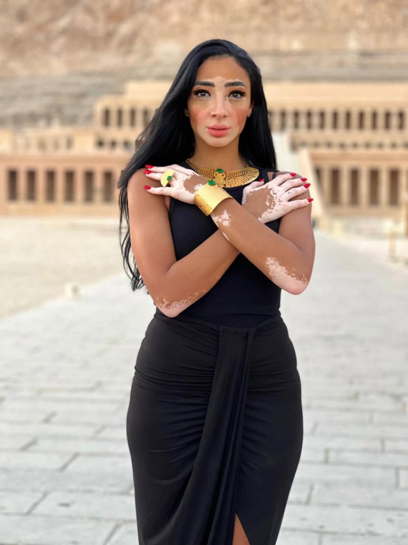 لوجينا صلاح.. مصابة بالبهاق وملكة جمال الكون