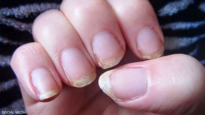 علامة على الأظافر.. انتبه مبكرا لارتفاع نسبة الكوليسترول