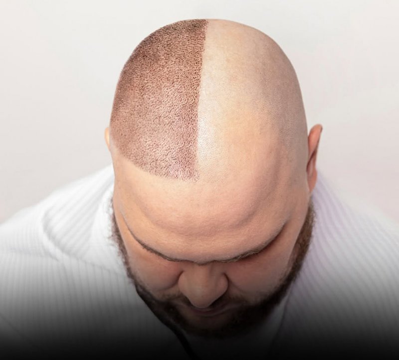 بالسكر.. العلماء يطورون علاجًا جديدًا للصلع