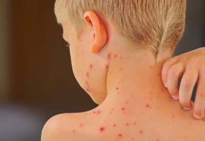 "الصحة" تتأكد: هل تطعم أطفالكم من الحصبة؟