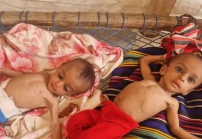 وفاة طفلة نازحة جراء سوء التغذية.. المجاعة تطرق أبواب اليمن
