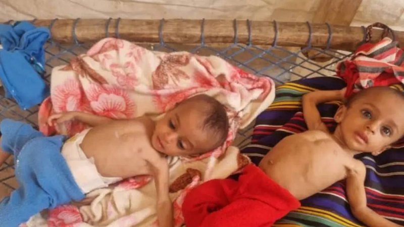وفاة طفلة نازحة جراء سوء التغذية.. المجاعة تطرق أبواب اليمن
