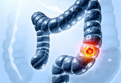 النشا المقاوم.. أطعمة بسيطة قد تقلل خطر السرطان لحد كبير