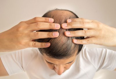 سبب غير متوقع قد يكون وراء إصابتك بالصلع!