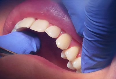 علماء يطورون هلاما لإصلاح الأسنان التالفة دون جراحة