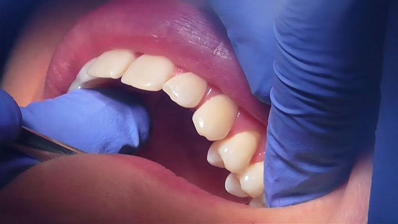 علماء يطورون هلاما لإصلاح الأسنان التالفة دون جراحة