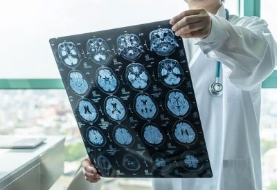 ابتكار ثوري.. قطرات للأنف لعلاج نوع خطير من السرطان