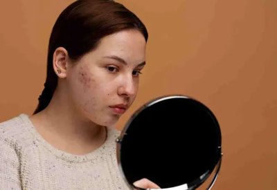 حب الشباب في الشتاء.. لماذا يكثر وكيف نتخلص منه؟