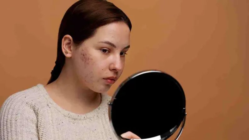 حب الشباب في الشتاء.. لماذا يكثر وكيف نتخلص منه؟