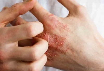 تشقق اليدين في الشتاء.. الأسباب الخفية وطرق الوقاية الفعالة