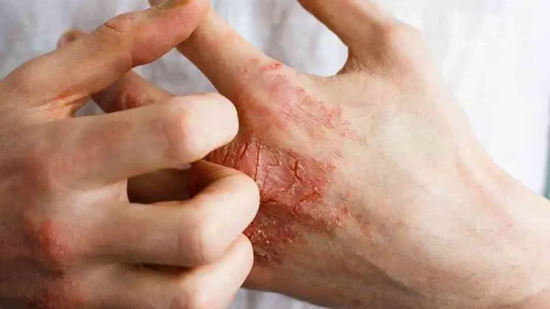 تشقق اليدين في الشتاء.. الأسباب الخفية وطرق الوقاية الفعالة